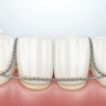 Permanent Retainers image