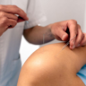 Dry Needling image
