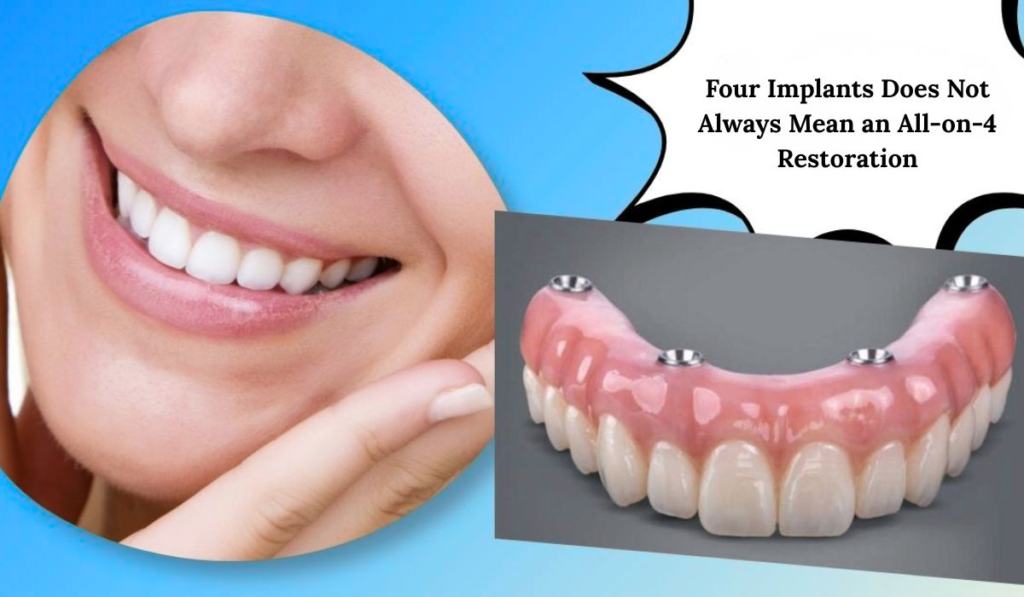 Four Implants image